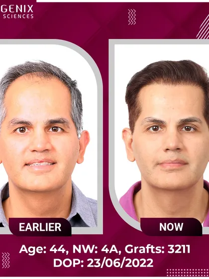 Real results for real people: a 44-year-old's successful 3211-graft transplant.