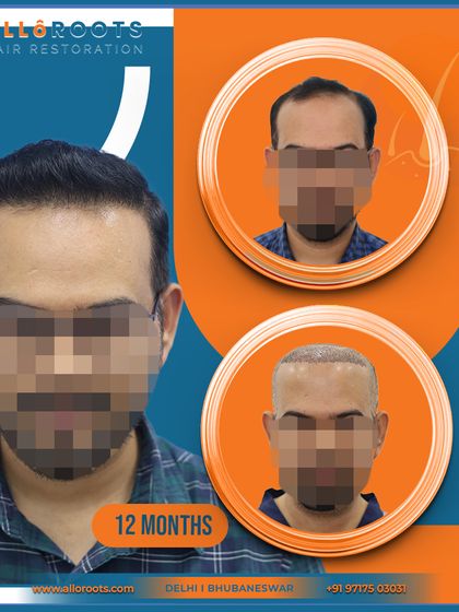 A 12-month transformation showing the before, post-op, and final result. This collage format gives a quick yet comprehensive overview of the patient's successful journey.