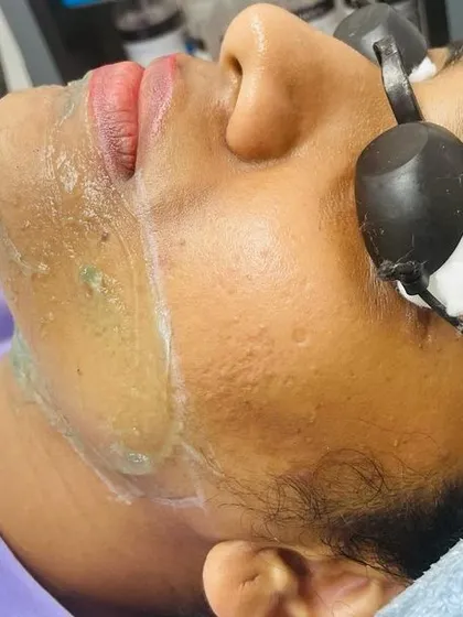 Here is a look at a facial hair removal session in progress. I take great care, especially on sensitive areas, using a cooling gel and protective eyewear to ensure the treatment is both safe and effective for achieving smooth skin.