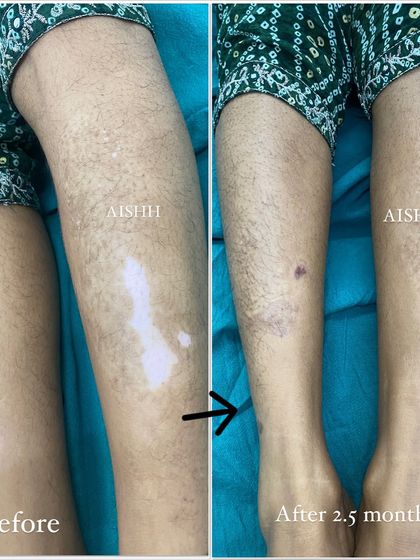 This patient saw a dramatic improvement in just 2.5 months. It is important to remember that vitiligo is a treatable, non-contagious condition, and no one should face social stigma because of it.