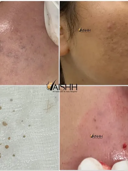 This case highlights the importance of proper diagnosis. What was treated as simple acne for a long time was actually calcinosis cutis, a rare condition involving calcium deposits. After a skin biopsy confirmed the diagnosis, we successfully treated it with laser and excision.