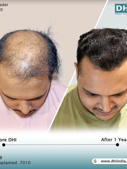 A top-down view of a 28-year-old client one year after his procedure. With 7,010 hairs implanted, his scalp is now fully covered with dense, natural-looking hair.