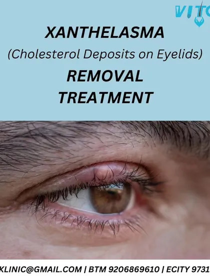 A close-up of Xanthelasma, the yellowish cholesterol deposits that can form on the eyelids. I provide effective removal treatments for this condition, addressing both the cosmetic concern and discussing the underlying causes.