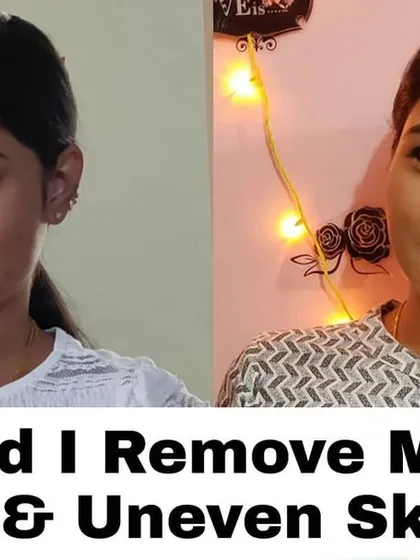 Here you can see how I tackled two common problems at once: dark circles and uneven skin tone. With a dedicated routine using gentle, natural remedies, I was able to lighten the area under my eyes and achieve a more balanced, glowing complexion.