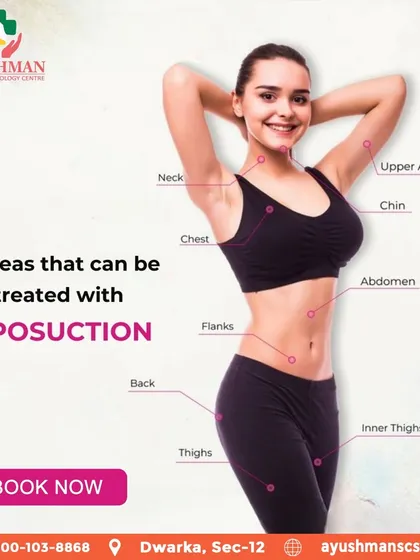 Liposuction is a precise surgical body sculpting tool that can target stubborn fat in up to nine different areas. This visual guide shows the versatility of the procedure, from the abdomen and thighs to the back and upper arms, helping you achieve a comprehensively contoured physique.