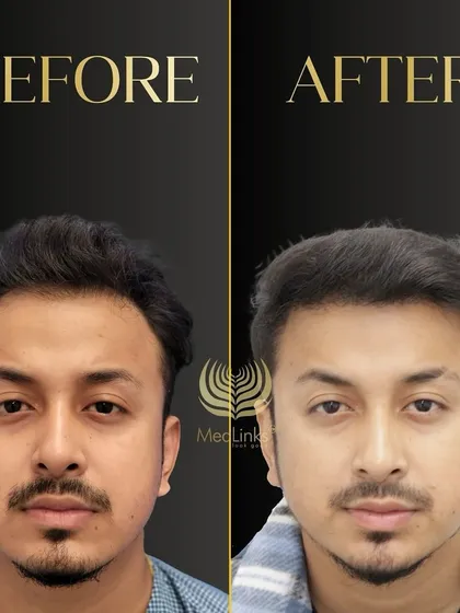 A great before and after transformation. The patient's new hair looks natural, dense, and has completely revitalized his appearance.
