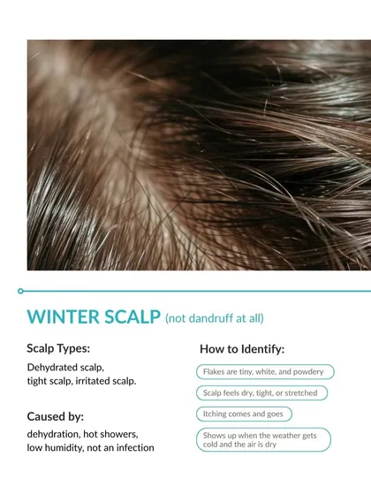 A "winter scalp" presents differently from dandruff. The flakes are usually tiny, white, and powdery, and the scalp feels tight and stretched. This is caused by dehydration and low humidity, not an infection, and needs a treatment focused on hydration.
