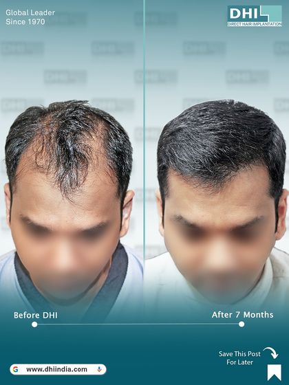 A top-down view of a 37-year-old client with Norwood Grade V hair loss, 7 months after receiving 8,226 implanted hairs. The density and coverage achieved are remarkable, transforming his appearance.