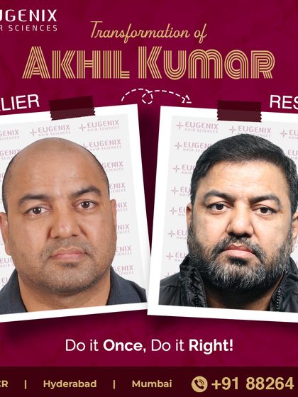 See the powerful transformation of former international boxer Akhil Kumar, who notes the procedure gave him a softer, more approachable look.