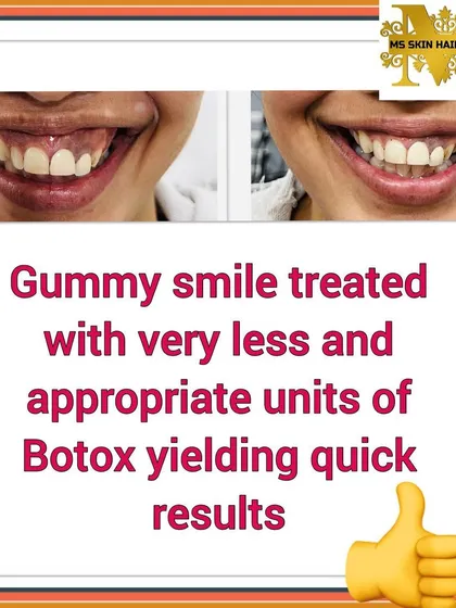 A "gummy smile" can be easily and effectively treated with a few units of Botox. This before and after shows how the treatment relaxes the upper lip muscle, allowing for a beautiful smile that reveals less gum.