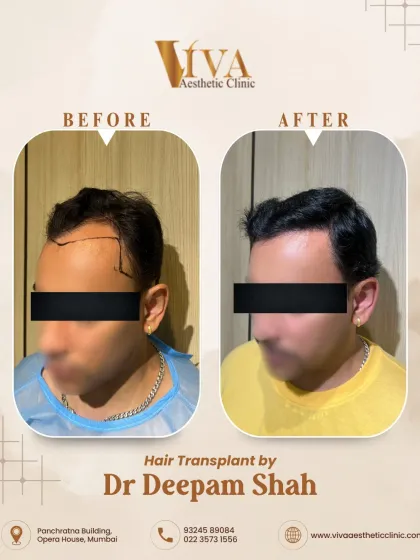 Here is the right-side view of the 2500-graft transplant. A successful hair restoration is a 360-degree success, looking natural from every angle.