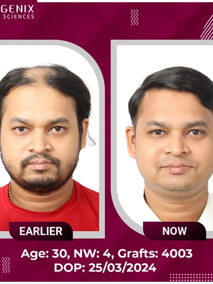 Witness the life-changing results for this 30-year-old after a 4003-graft procedure for Grade 4 baldness.
