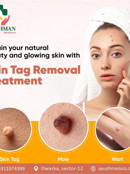 Regain your natural beauty and glowing skin with my skin tag, mole, and wart removal treatments. I can help you achieve the clear, smooth skin you desire.