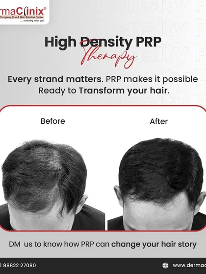 This before-and-after photo shows the transformative power of High-Density PRP. It can take hair from thinning to thriving by boosting natural growth and density.