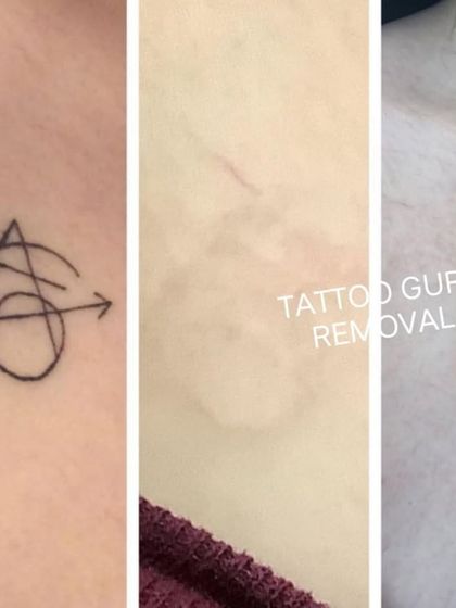 This is a multi-stage removal of a symbol on the chest. It shows the original tattoo, the fading process, and the final clear result.