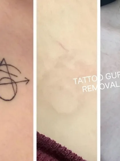 This is a multi-stage removal of a symbol on the chest. It shows the original tattoo, the fading process, and the final clear result.