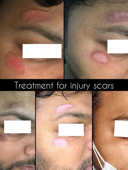A closer look at the treatment process for injury scars. Each stage requires a different approach, from managing initial inflammation to breaking down scar tissue and restoring normal skin tone.