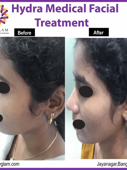 A side-profile view of a Hydra Medical Facial transformation. You can see a noticeable improvement in the skin's texture and a reduction in minor blemishes along the jawline and cheek.