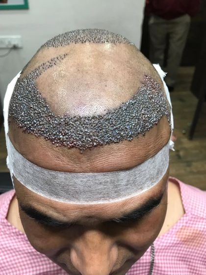 This is what a high density hair transplant looks like immediately after the procedure. Each follicle is carefully implanted to create a new, dense hairline that will grow in naturally over the coming months.