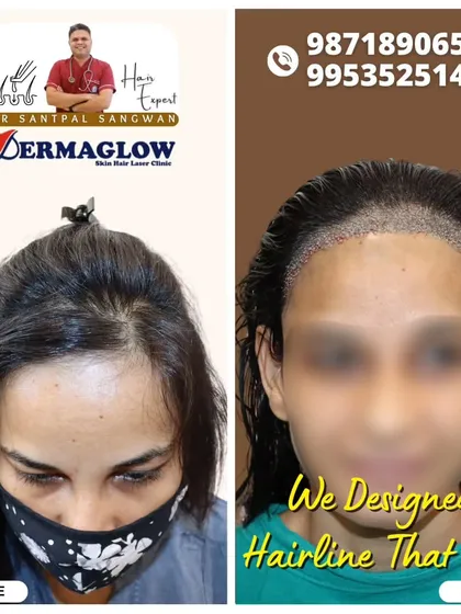 Hair loss in women requires a unique approach. For this client, we performed a Follicular Unit Extraction (FUE) transplant to redesign her hairline, creating a result that is both natural and lasting.