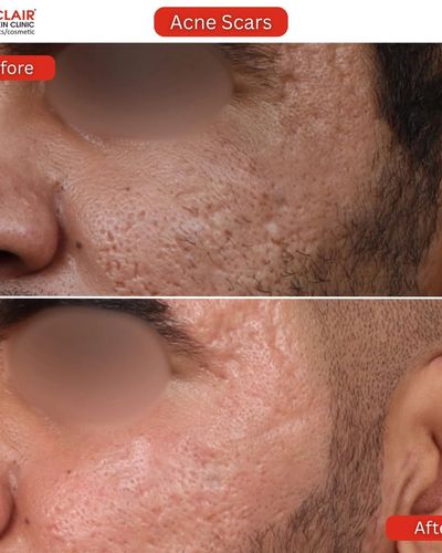 Skin Resurfacing & Scar Treatment