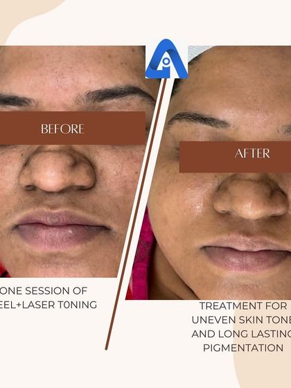 Another angle showing the improvement in facial pigmentation after a single session of a peel and laser toning. This combination helps break down pigment and exfoliate the skin for faster results.