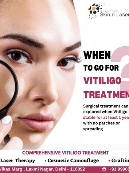 Surgery is not for everyone. I only recommend a surgical treatment like grafting when the Vitiligo has been stable for at least one year, with no new patches or spreading. This ensures the best possible outcome.