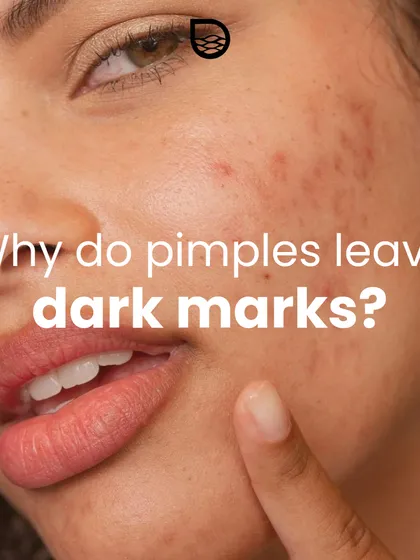 Many patients ask why pimples leave dark marks. This is the start of a series explaining post-inflammatory hyperpigmentation and how to manage it.