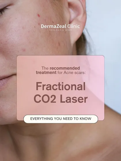 Acne scars don't have to be a permanent concern. My Fractional CO2 Laser treatment is a recommended, advanced solution that works deep within the skin to stimulate collagen and smooth out texture for a clearer complexion.
