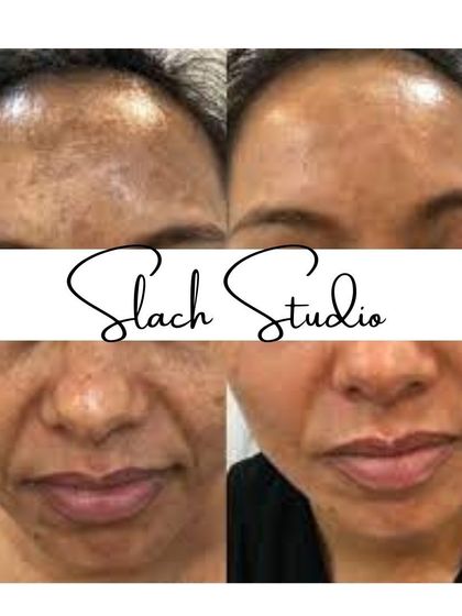 A great result showing the evening out of skin tone and reduction of dark patches across the face.