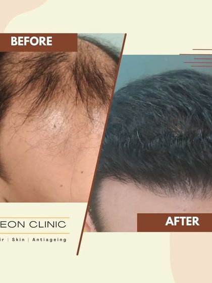 A powerful before-and-after showcasing significant regrowth and coverage. Our goal is to help you regain a full head of hair.