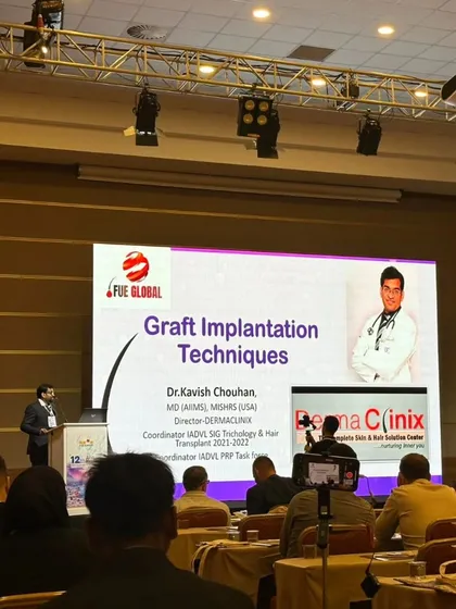 Here I am presenting on 'Graft Implantation Techniques' at the FUE Global World Congress. My involvement in leading international conferences ensures I am always using the most advanced and effective hair restoration methods for my patients.