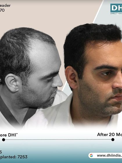 A side-profile view of the same client's 20-month transformation. The hair looks healthy, dense, and completely natural, demonstrating the permanence and quality of the DHI technique.