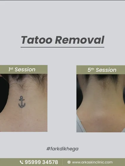 The results speak for themselves. This is the progress after five sessions of our painless laser tattoo removal. We can effectively fade and remove unwanted ink, giving your skin a fresh start.