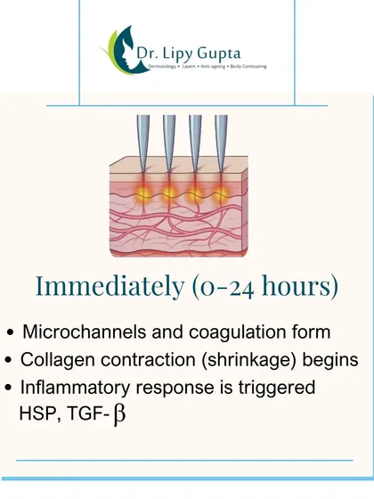 Immediately after microneedling, microchannels are formed, triggering an inflammatory response and causing collagen to contract. This is the first step in the skin's renewal process.