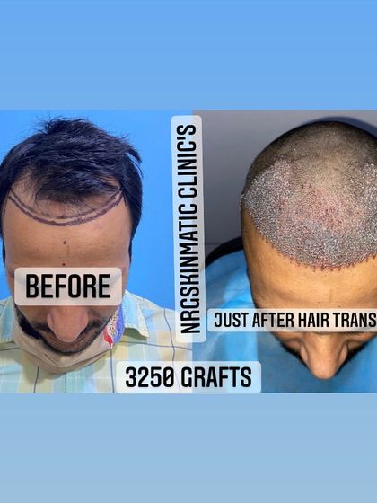 A top-down view of a client before and immediately after a 3250-graft hair transplant. This shows the extensive coverage we can achieve in a single session to address frontal baldness.