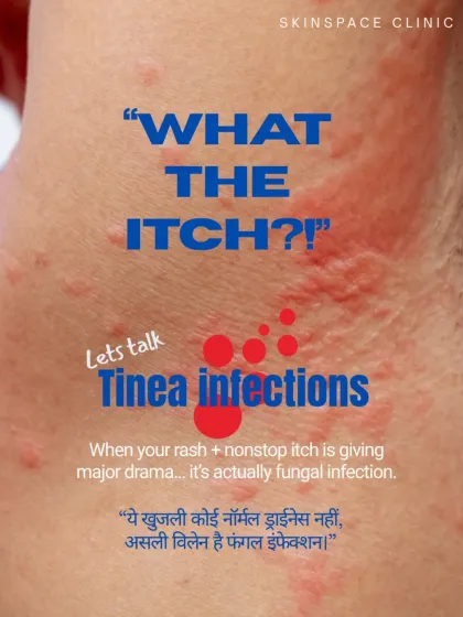When you have a rash with a nonstop itch, it is often a fungal infection like Tinea. This is not normal dryness; it is an active infection that needs to be treated with antifungal medication.
