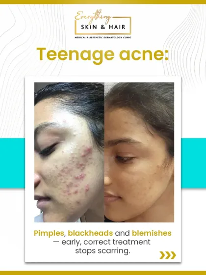 This before-and-after result highlights the successful treatment of teenage acne. By addressing pimples, blackheads, and inflammation early, we effectively cleared the active breakouts and prevented the formation of permanent scars.