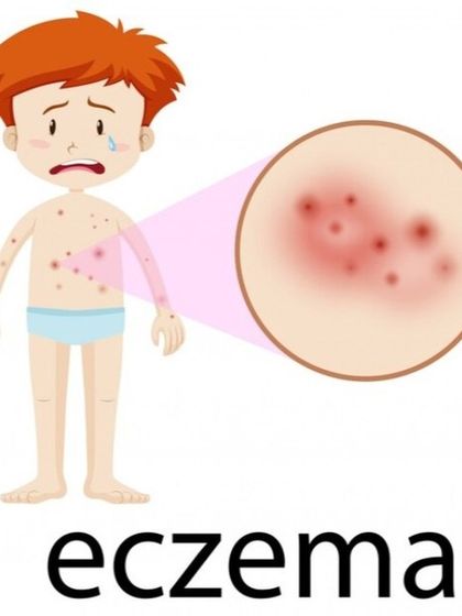 Atopic dermatitis, or eczema, in children often presents as dry, itchy, red patches. My goal is to provide relief by repairing the skin barrier with gentle moisturizers and, if needed, safe prescription medications to control flare-ups.