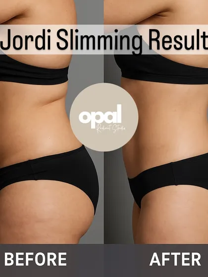 This is the kind of transformation possible with our Jordi Shape treatment. This client was thrilled to see a significant reduction in stubborn belly fat and a more contoured, smoother waistline. This result was achieved without any surgery, focusing on a safe and gradual slimming process.