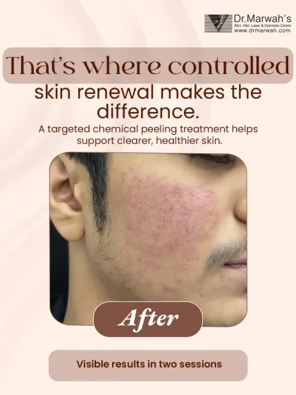 Here is the same patient's skin after just two sessions of a controlled, targeted chemical peel. The treatment has visibly calmed the active breakouts, reduced redness, and initiated a healthier skin renewal process, leading to a much clearer complexion.