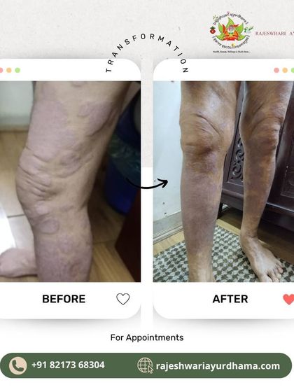 This image documents the healing journey for a client with a severe skin condition on their leg. The 'after' photo shows a dramatic reduction in scaling and inflammation, demonstrating the effectiveness of long term Ayurvedic care.