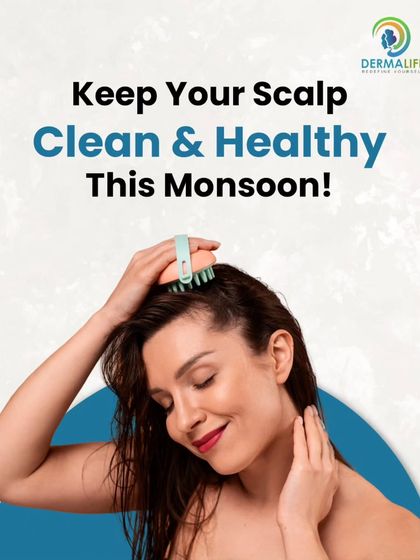 Keeping your scalp clean and healthy is one of the most important steps to prevent hair fall during the monsoon.