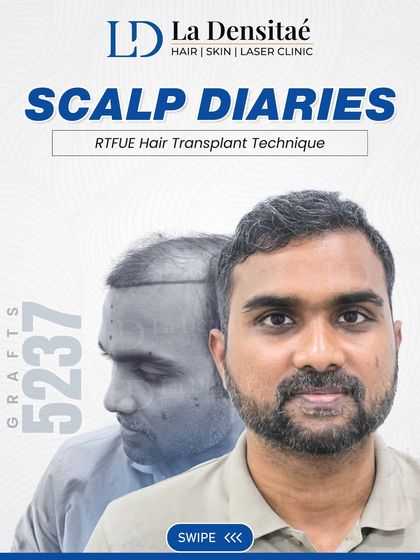 A great hairline begins with a solid plan. For Mr. Koushik Verma, I focused on hairline design and graft distribution, placing 5,237 grafts with the RT-FUE technique to ensure the new hair blends seamlessly with his original texture.