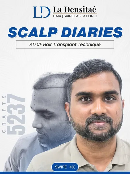 A great hairline begins with a solid plan. For Mr. Koushik Verma, I focused on hairline design and graft distribution, placing 5,237 grafts with the RT-FUE technique to ensure the new hair blends seamlessly with his original texture.