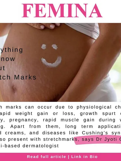 Stretch marks are a common concern, especially during pregnancy or periods of weight change. I explain what causes them and discuss the treatment options available to reduce their appearance, particularly when addressed early.