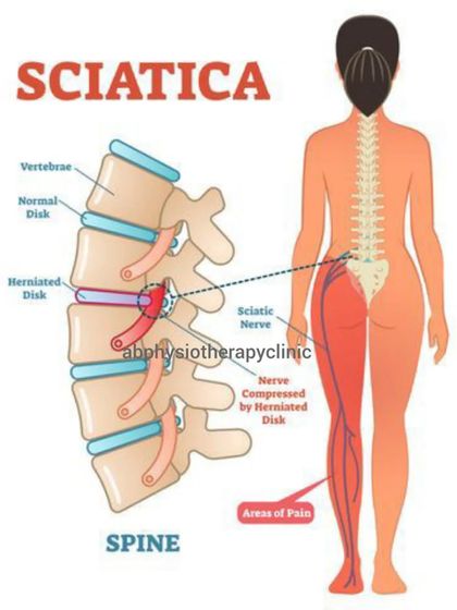 This diagram clearly illustrates how a herniated disc can compress the sciatic nerve, causing pain to radiate down the leg. My treatment focuses on relieving this pressure through targeted exercises and manual therapy.