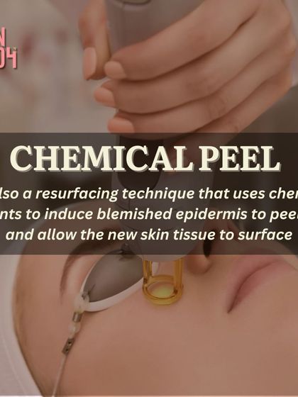 A chemical peel is a powerful resurfacing technique. It uses a specialized chemical solution to induce the blemished top layer of skin to peel off, allowing new, smoother skin tissue to surface.