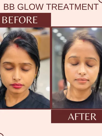 Experience the immediate radiance of a BB Glow treatment. This client's skin looks visibly brighter, more even-toned, and refreshed right after the procedure. It's a fantastic non-invasive option for long-lasting complexion enhancement.