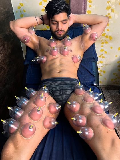 Another view of a client undergoing a comprehensive dry cupping treatment on his chest, arms, and legs.